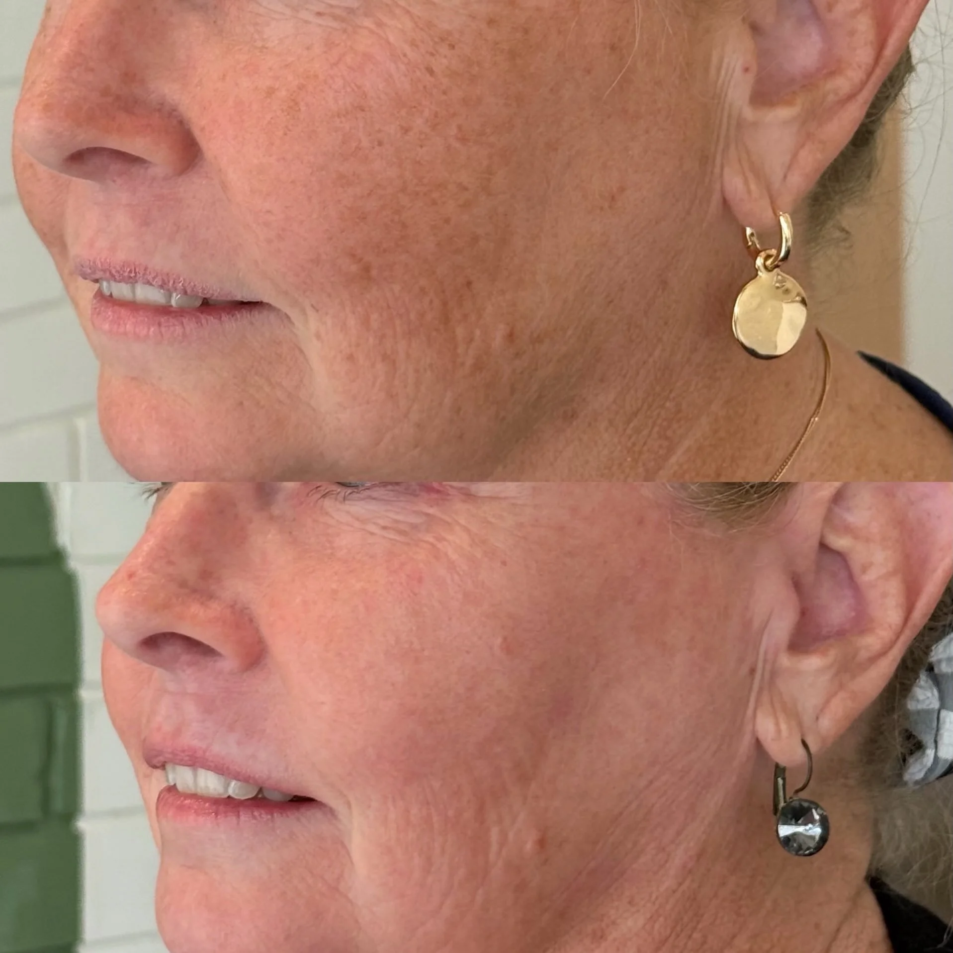 Sun damage builds up gradually over time, often becoming more visible as we age.

The good news? We can do something about it.

Reset your skin with our advanced skin rejuvenation treatments, designed to target accumulated sun damage, pigmentation an
