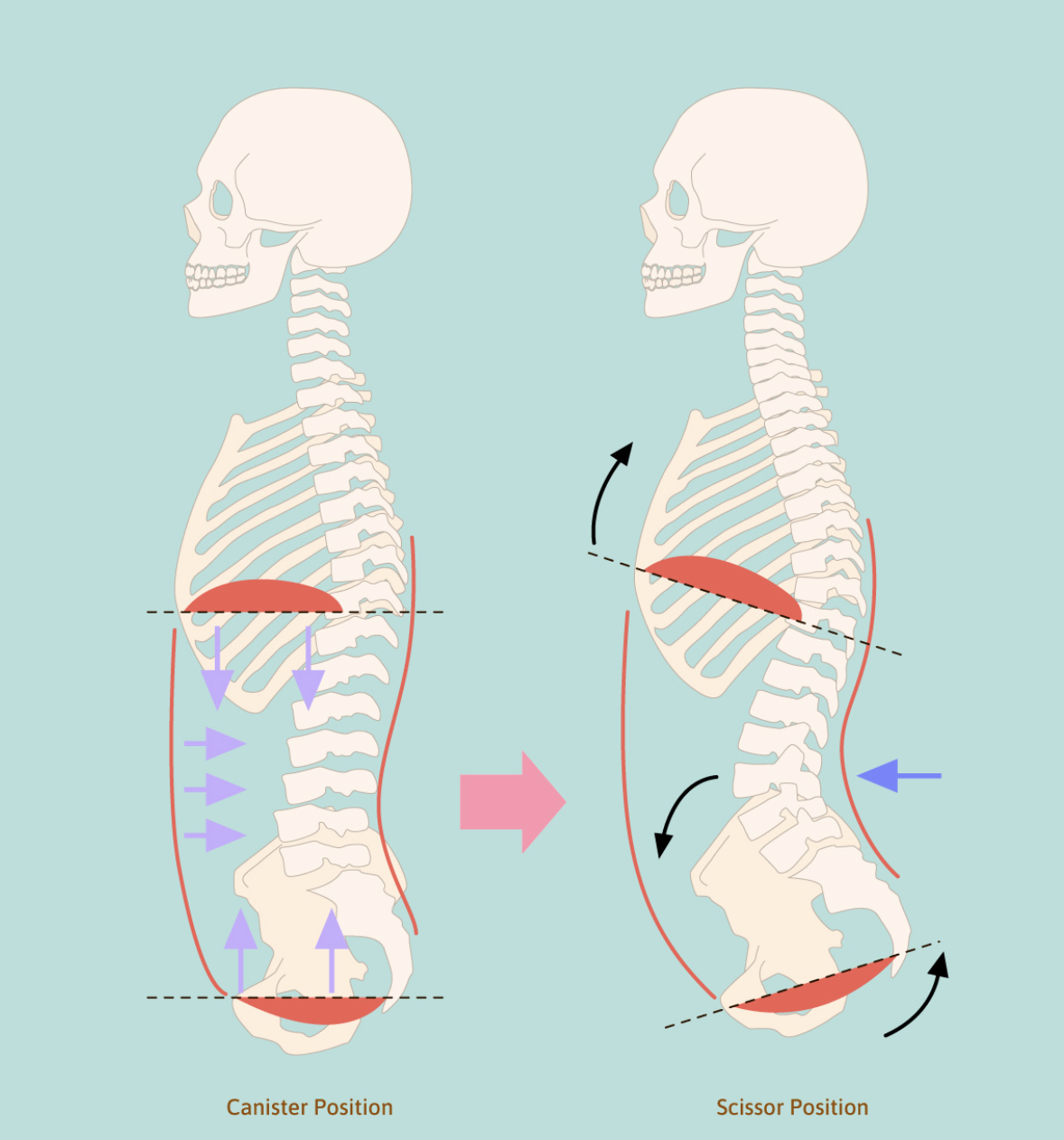 How To Fix Flared Ribs - Posture Direct