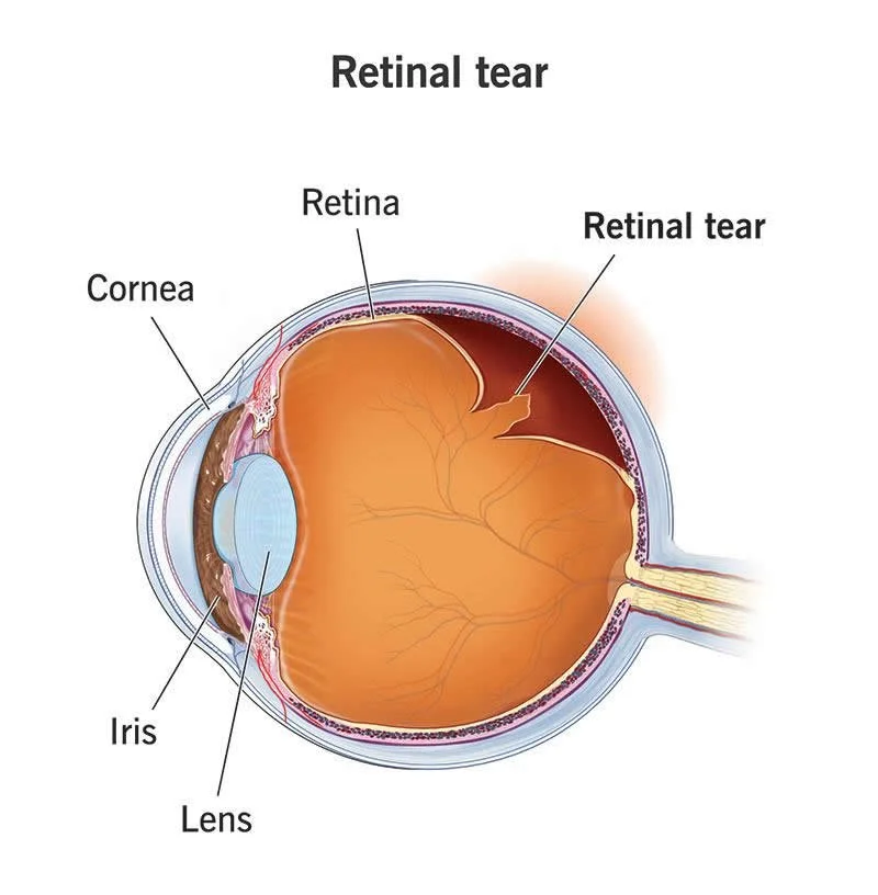 I Nearly Lost My Sight... The Symptoms I Wish Everyone Knew