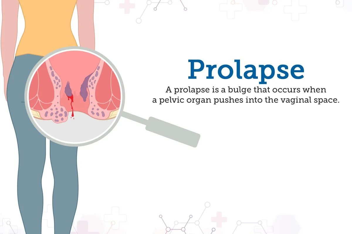 Prolapse: The Women’s Health Issue We Really Need to Talk About