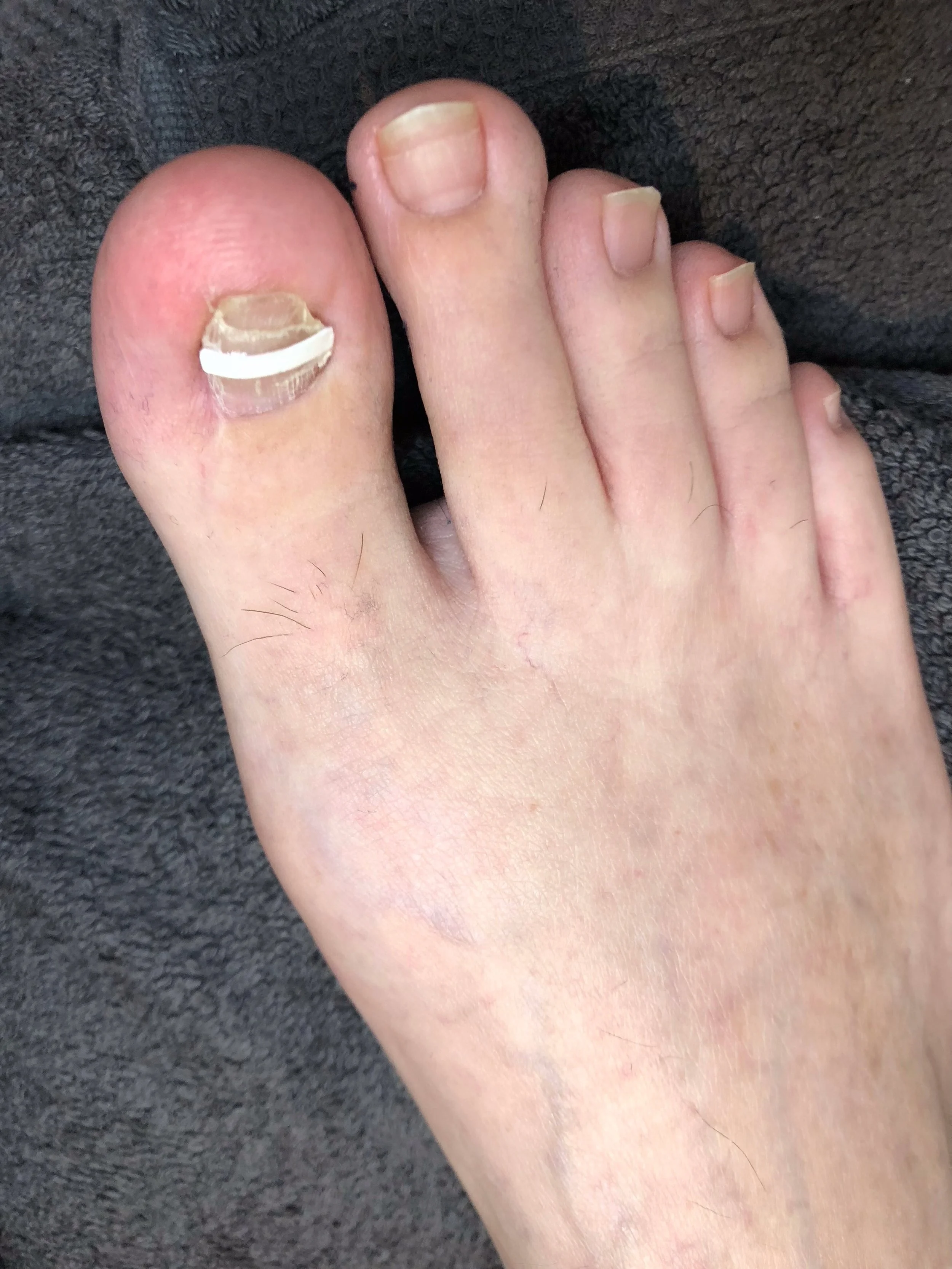 Behandeling cliënt 1 | vóór