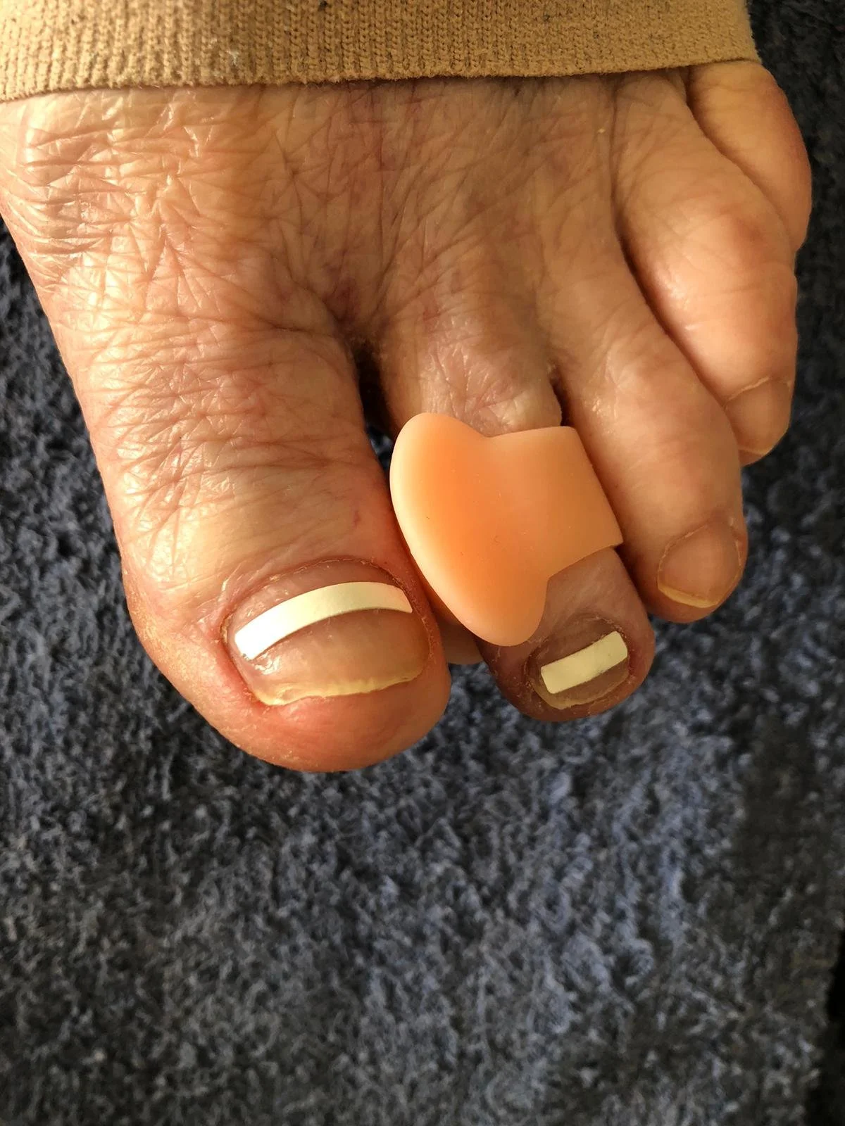 Behandeling cliënt 2 | vóór