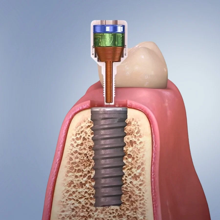 A New Horizon in Peri-implantitis Management: A Clinical Perspective on Focused PEMF Therapy