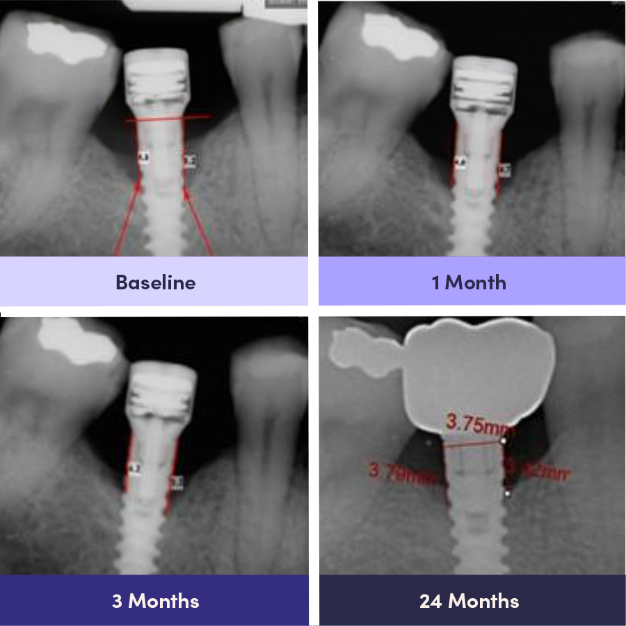 Accelerating Dental Implant Healing: A ClinicalPerspective on PEMF Technology and the Magdent MED