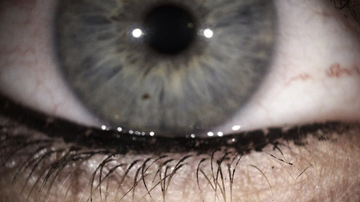 Eyeliner and makeup along the eyelid margin near the meibomian gland openings.