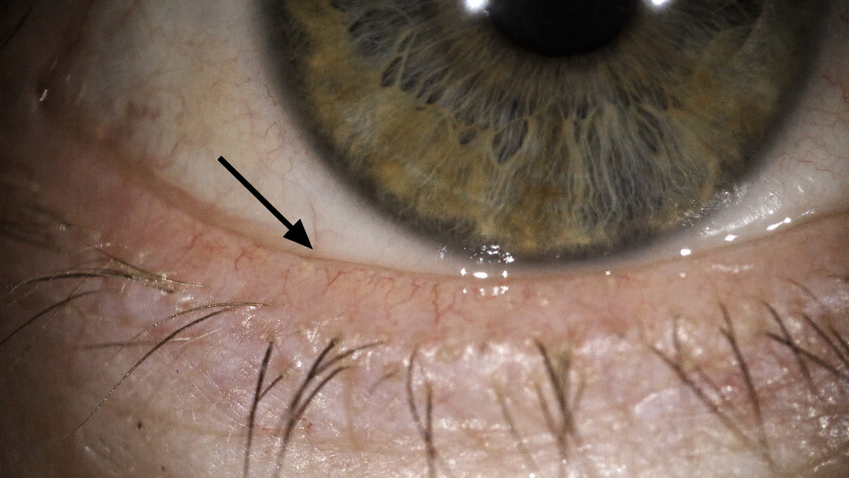 Close-up of ocular rosacea showing visible blood vessels along the lower eyelid margin