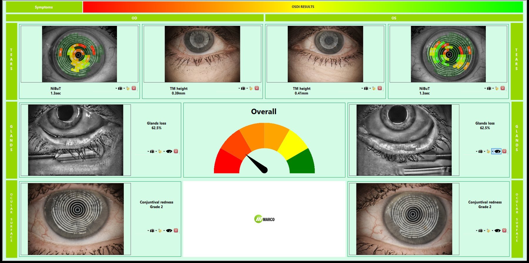 Marco Phoenix dry eye report used to evaluate tear stability, redness, and meibomian gland findings