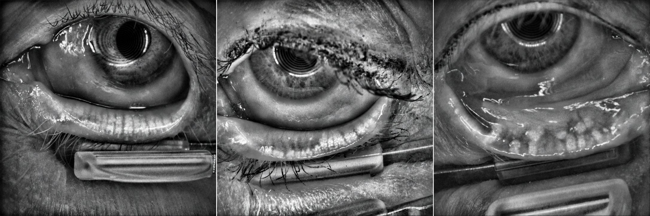 Meibography images showing healthy and damaged meibomian glands.