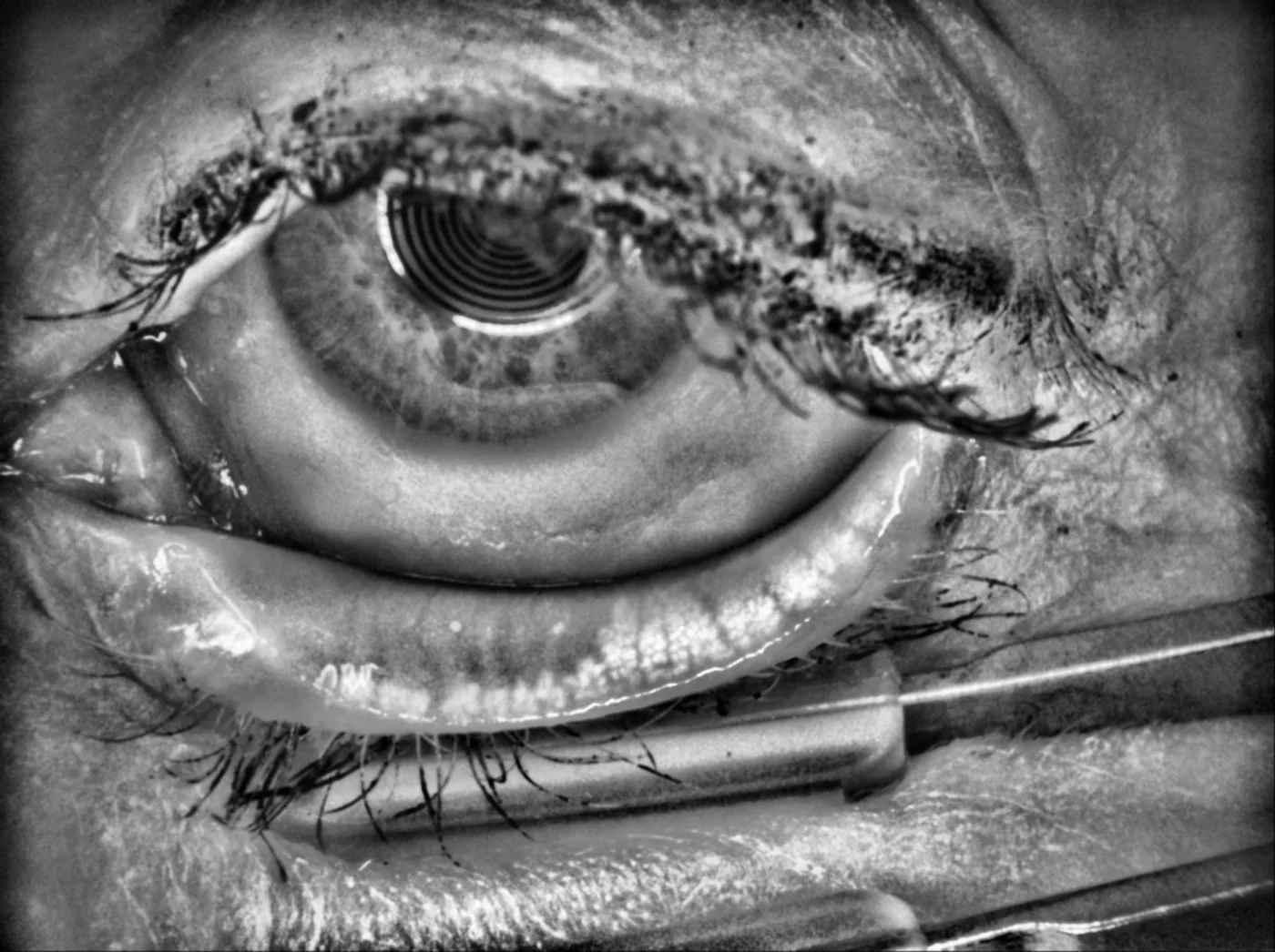 Meibography image showing moderate meibomian gland loss related to meibomian gland dysfunction and dry eye
