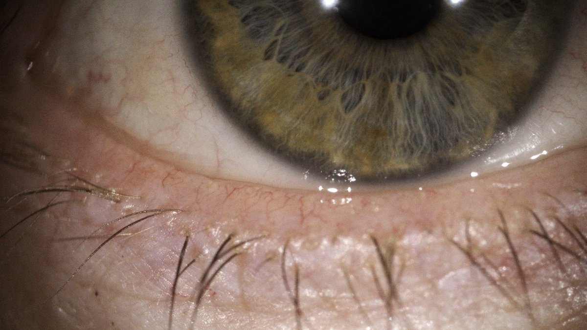Tiny blood vessels along the eyelid margin showing signs of ocular rosacea-related inflammation.
