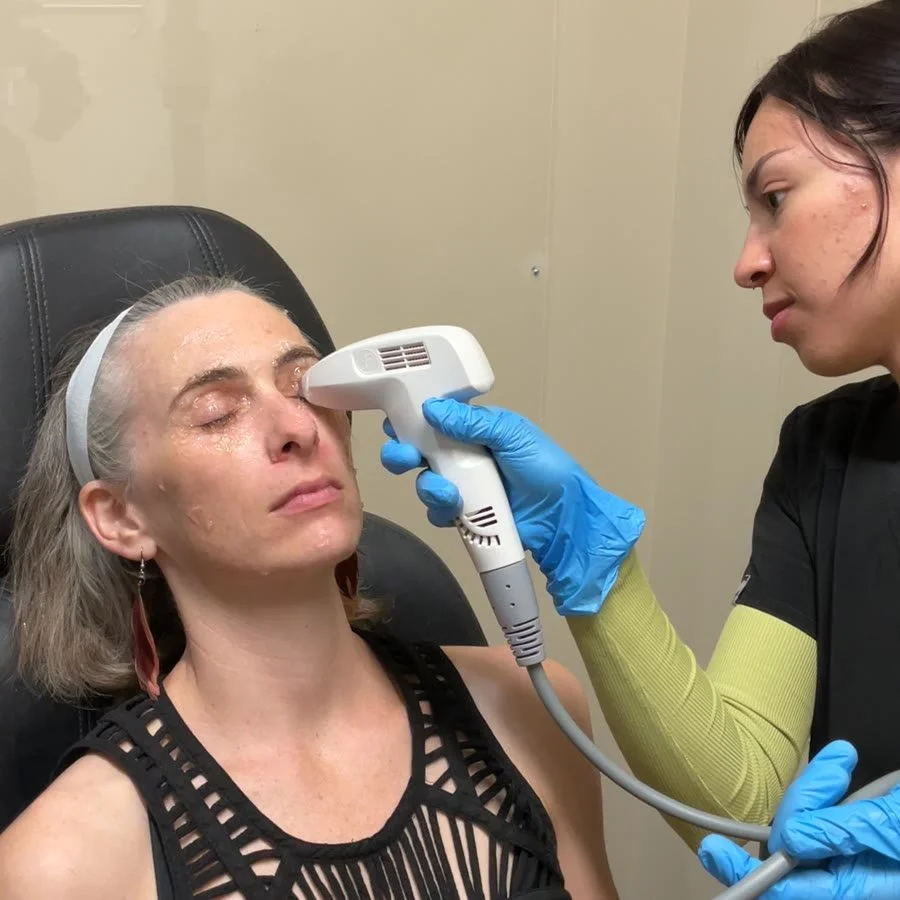 Radiofrequency treatment for meibomian gland dysfunction and dry eye