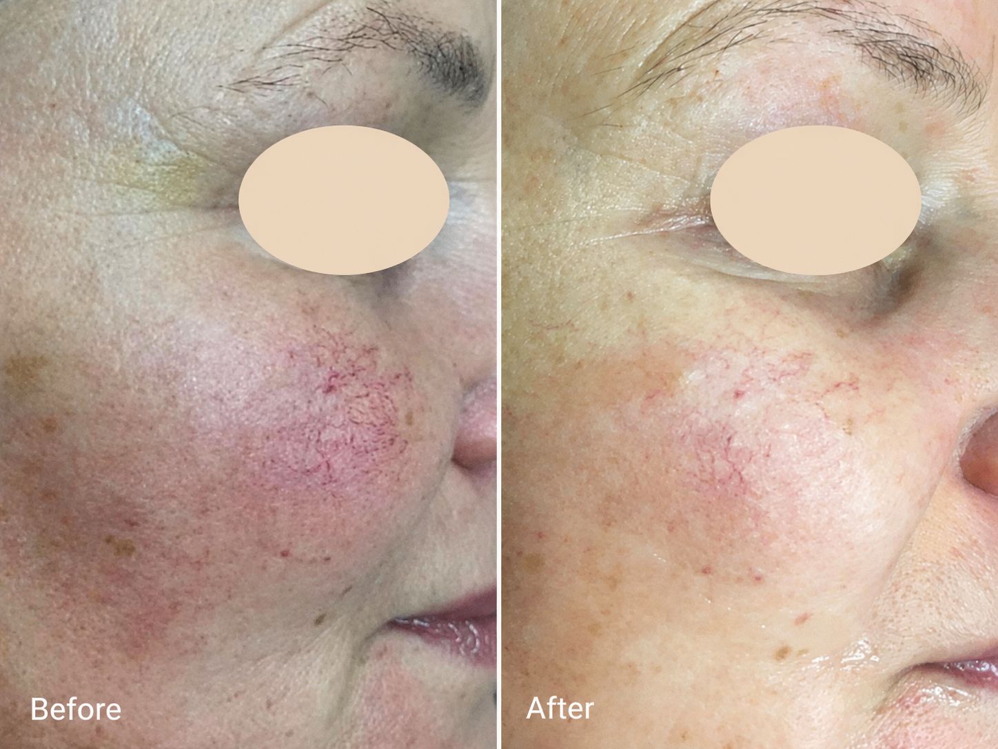 Before and after IPL treatment showing reduced facial redness related to rosacea