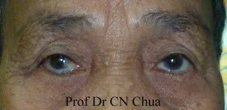 Common eyelid problems related to dry eye disease, Part 4: The eyelid “innie.”