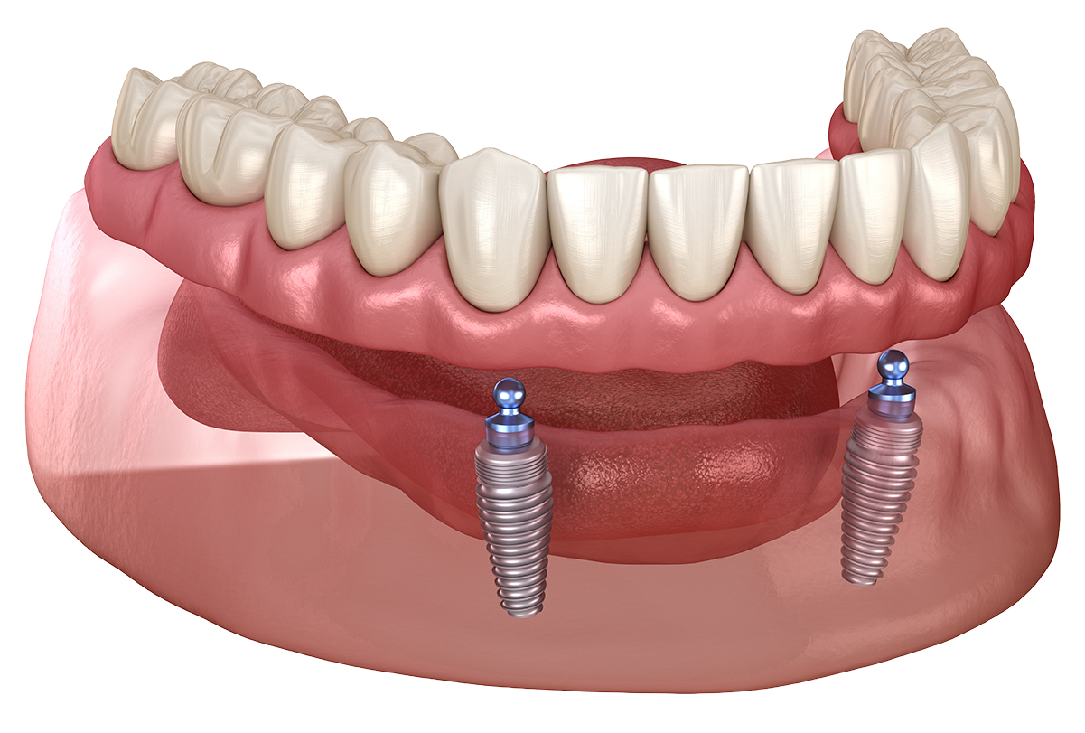Snap In Dentures Chattanooga TN - Hixson Dental Group