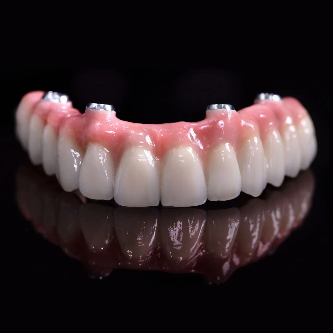 What Are All on 4 Dental Implants and How Do They Differ From Traditional Implants?