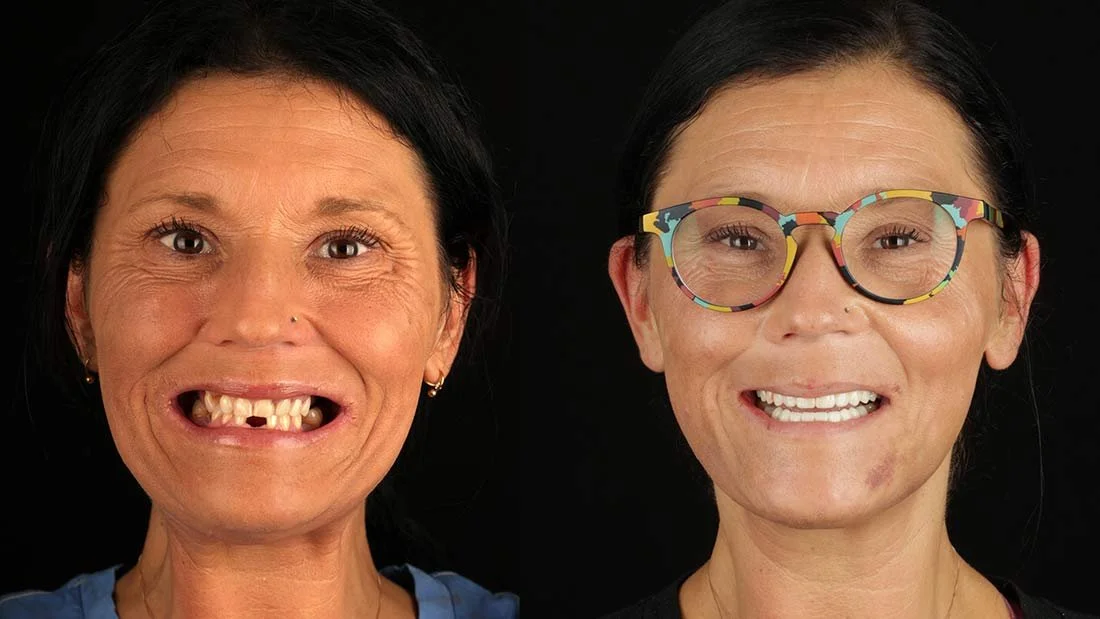 Chattanooga Dentist Implants Before and After Photo Chattanooga Dentist