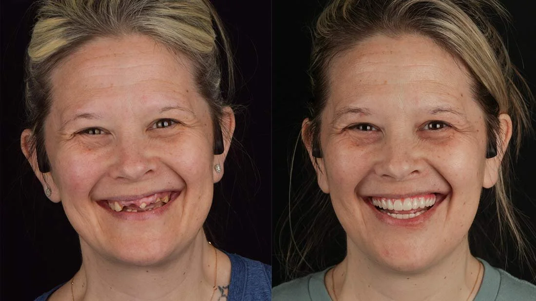 All-on-4 Dental Implants Chattanooga Before and After Photo
