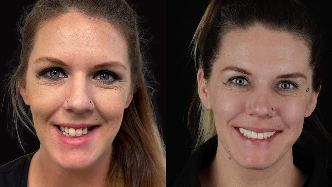 Chattanooga Dentist All-on-4 Dental Implants Before and After Photo Chattanooga