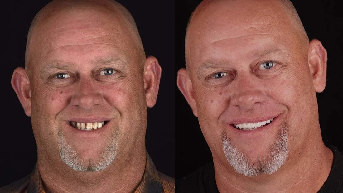All-on-4 Dental Implants Before and After Photo Chattanooga