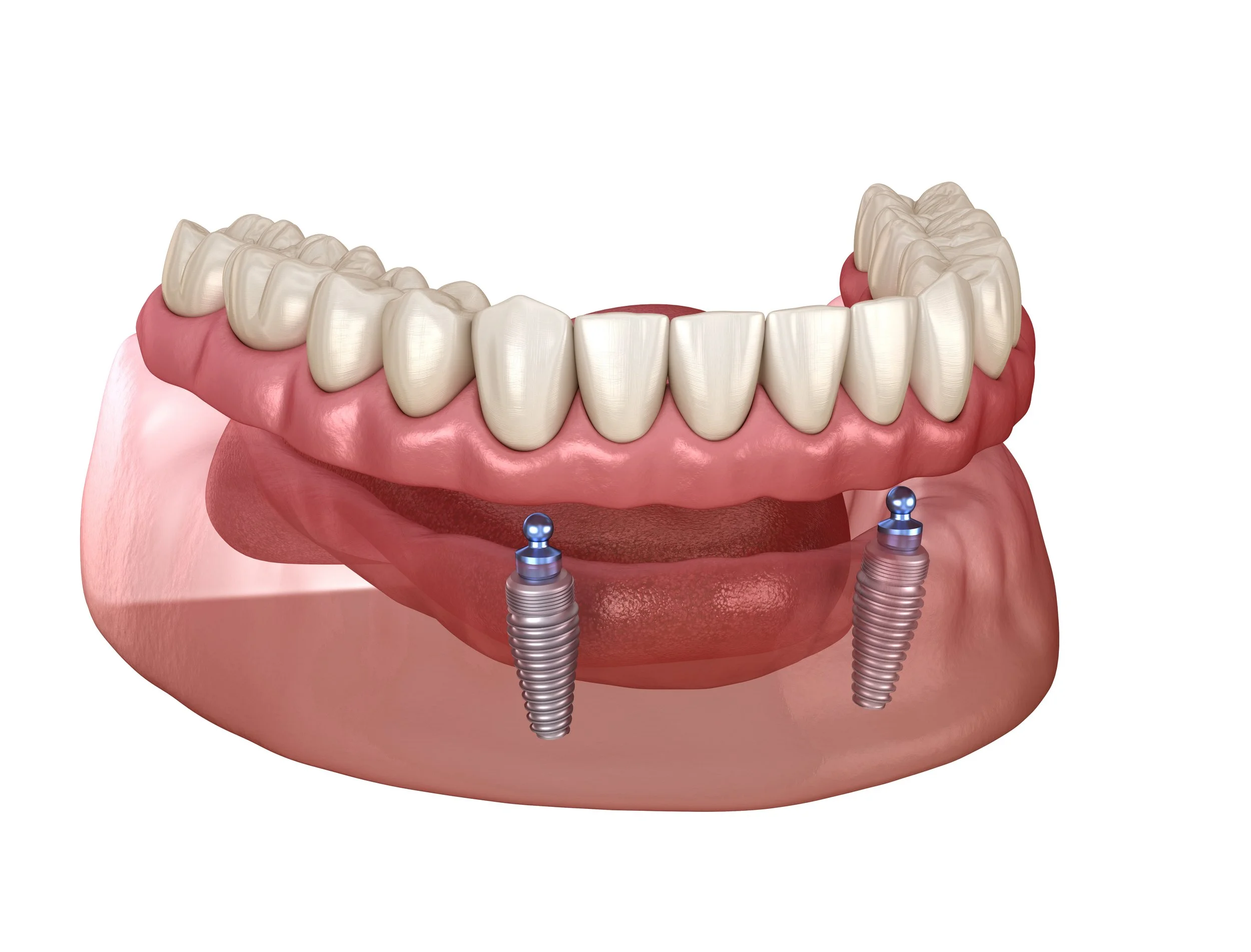 Snap In Dentures Chattanooga TN - Hixson Dentist