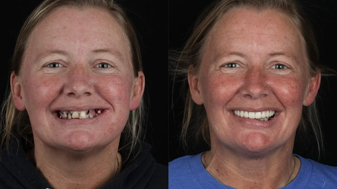 Chattanooga Dentist All-on-4 Dental Implants Before and After Photo Chattanooga Dentist