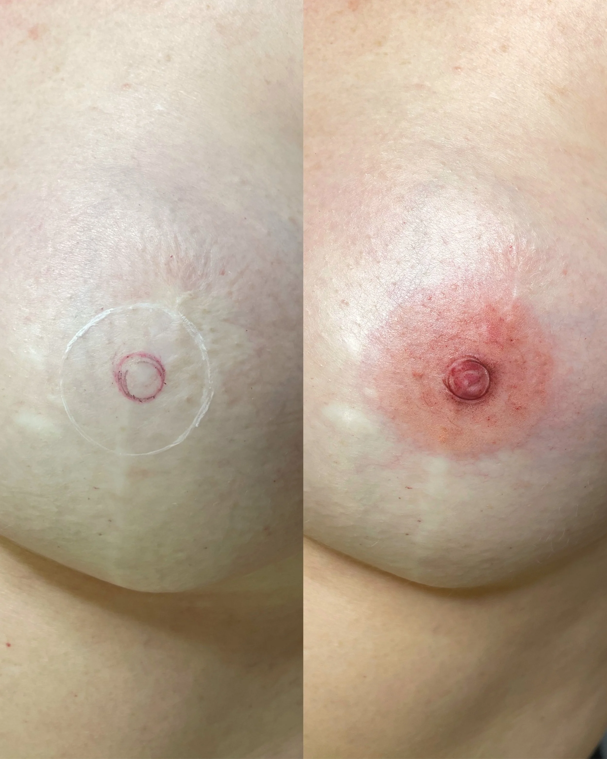 Areola tattooing