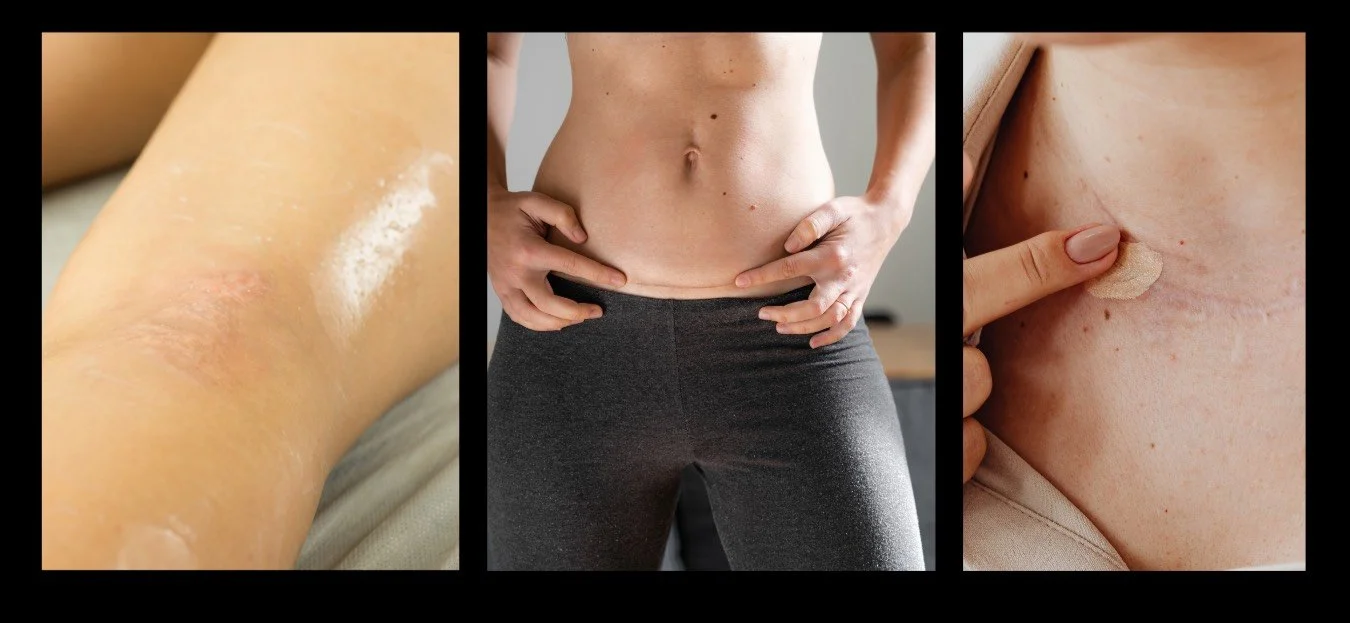 Scar Camouflage: How Permanent Makeup Can Restore Confidence