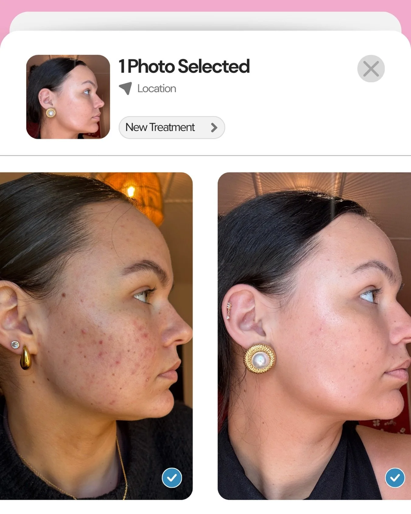 We&rsquo;ve been busy working on something special that&rsquo;s taken Haylee&rsquo;s skin on this journey 🙌🏼 Safe to say we&rsquo;re quite pleased with this before and after. 

Curious about what we did? Let us know and we&rsquo;ll share very soon 