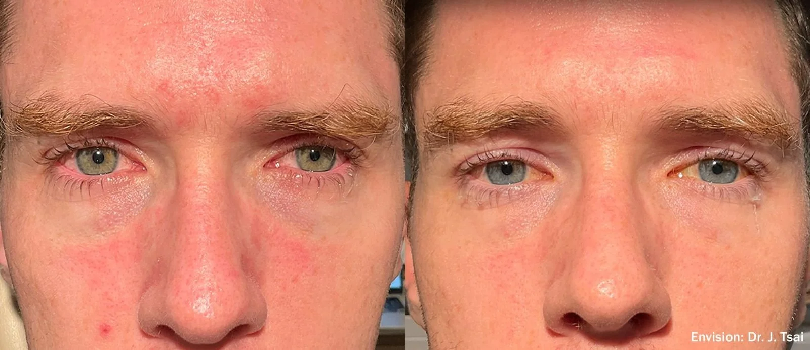 Side-by-side comparison of a person's face with visible skin redness and irritation before and after treatment.