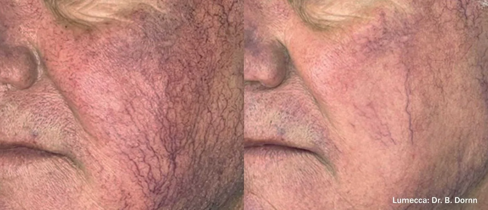 A close-up image showing a person's facial skin with visible redness, dryness, and broken blood vessels, indicating a skin condition. The image is credited to Dr. B. Dornn.