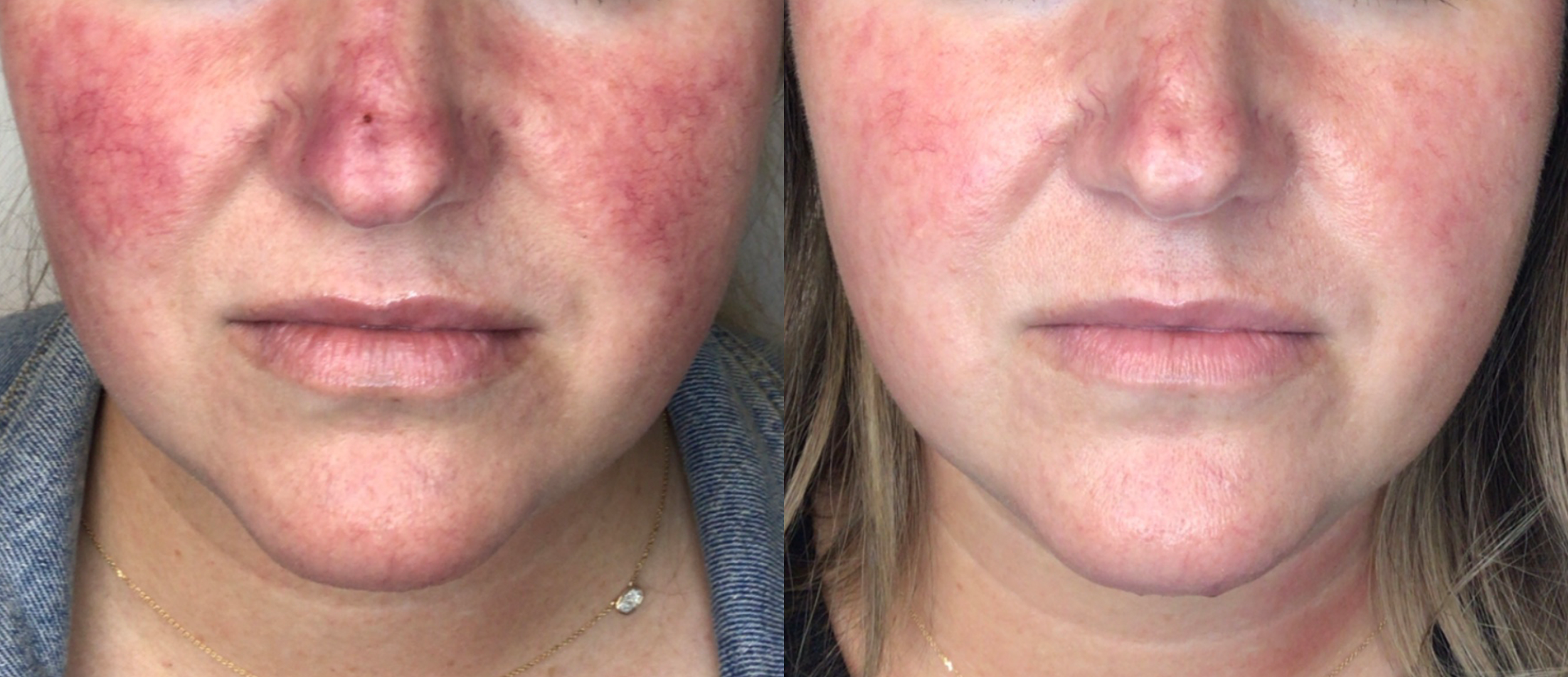 Comparison of a woman's face showing skin improvement. The left side has redness and uneven skin tone, while the right side has clearer, smoother skin with less redness.