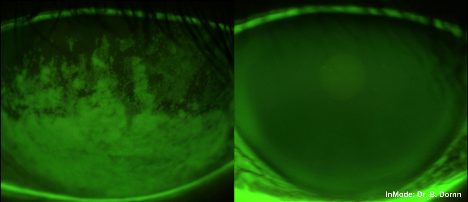 Close-up of a human eye with green illumination, showing detailed textures of the iris on the left, and the pupil on the right, with a small white text indicating 'InMode: Dr. B. Dorhn' at the bottom right corner.
