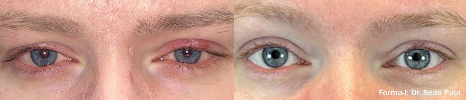 Close-up of a person's eyes, showing two different eye conditions or makeup styles side by side.