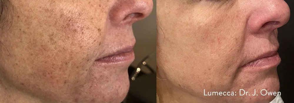 Comparison of skin appearance showing improvement in texture and pigmentation after treatment, by Dr. J. Owen.