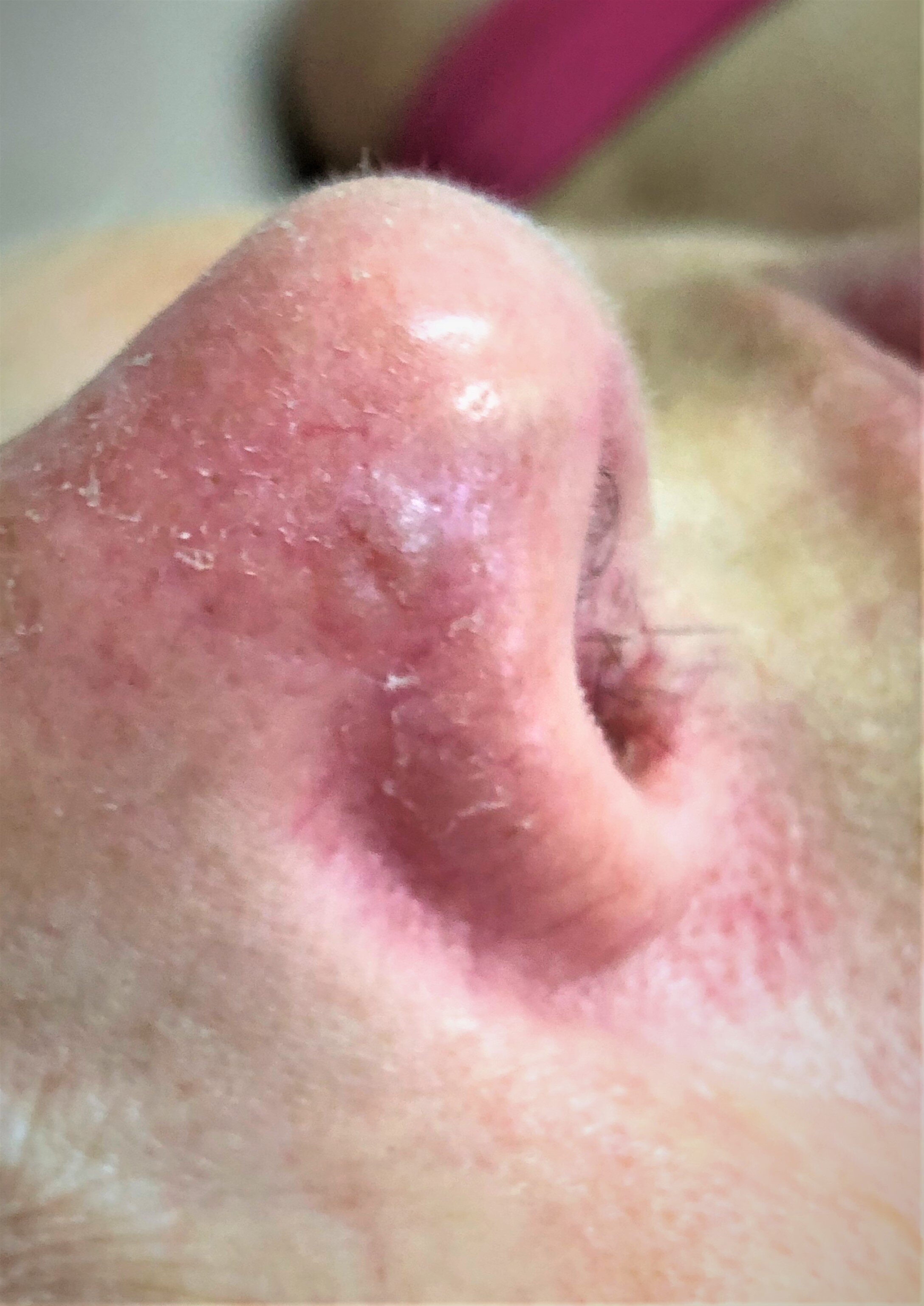 basal cell carcinoma nose scar