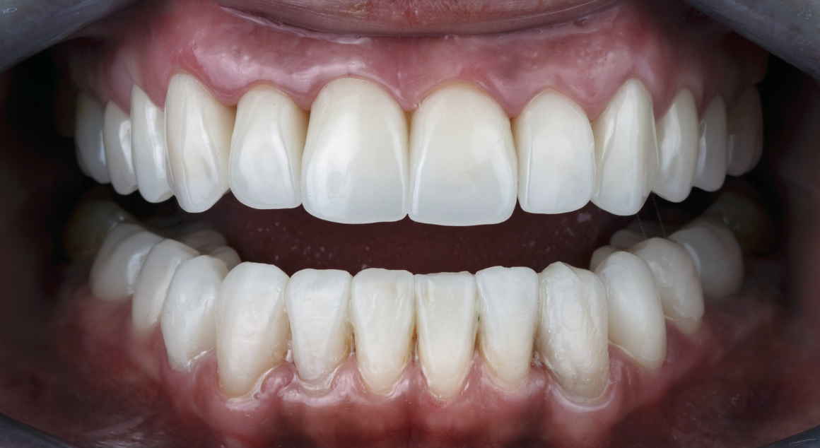 Close-up of a person's open mouth showing upper and lower teeth, with upper teeth appearing as dental veneers or crowns.