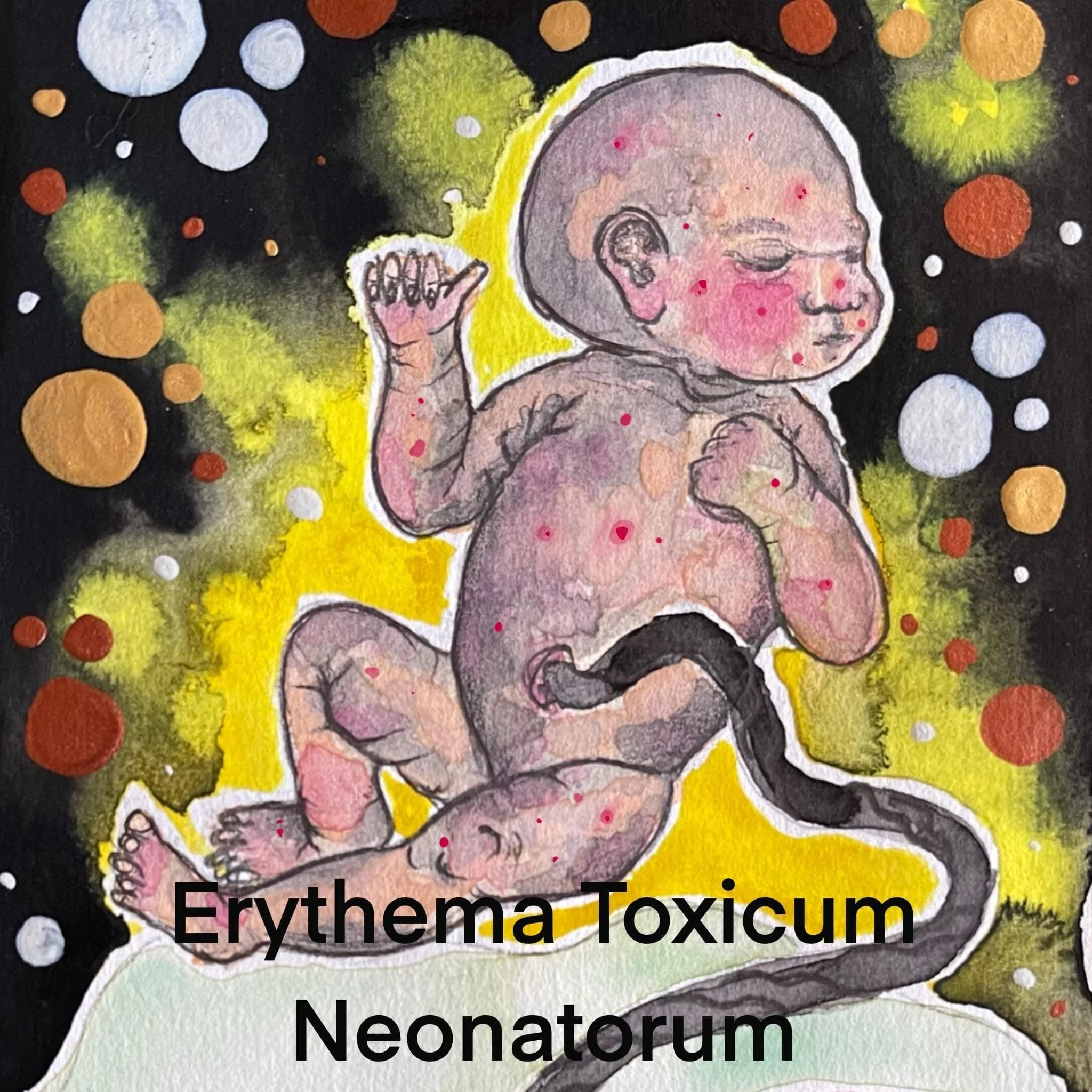 🔴Erythema Toxicum Neonatorum🔴