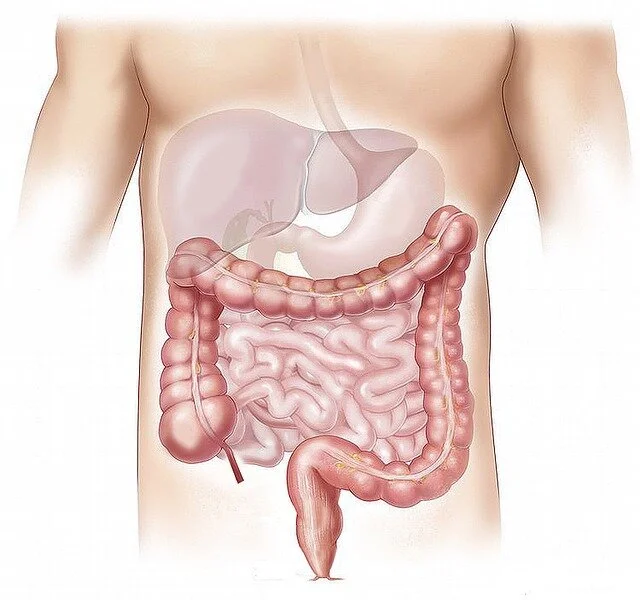 Crohn’s Disease Exclusion Diet (CDED) Review