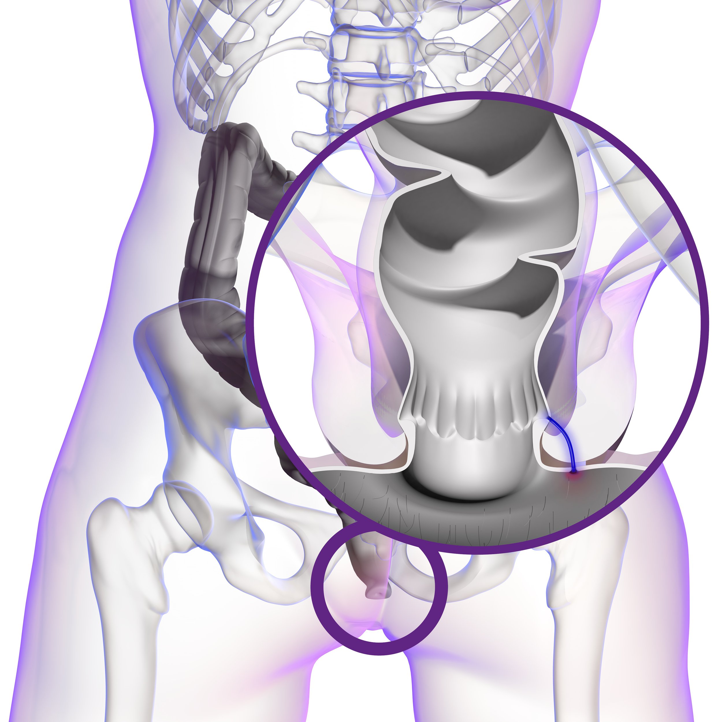 ILLUSTRATIONS 3 FISTULE 2024 03 12.jpg