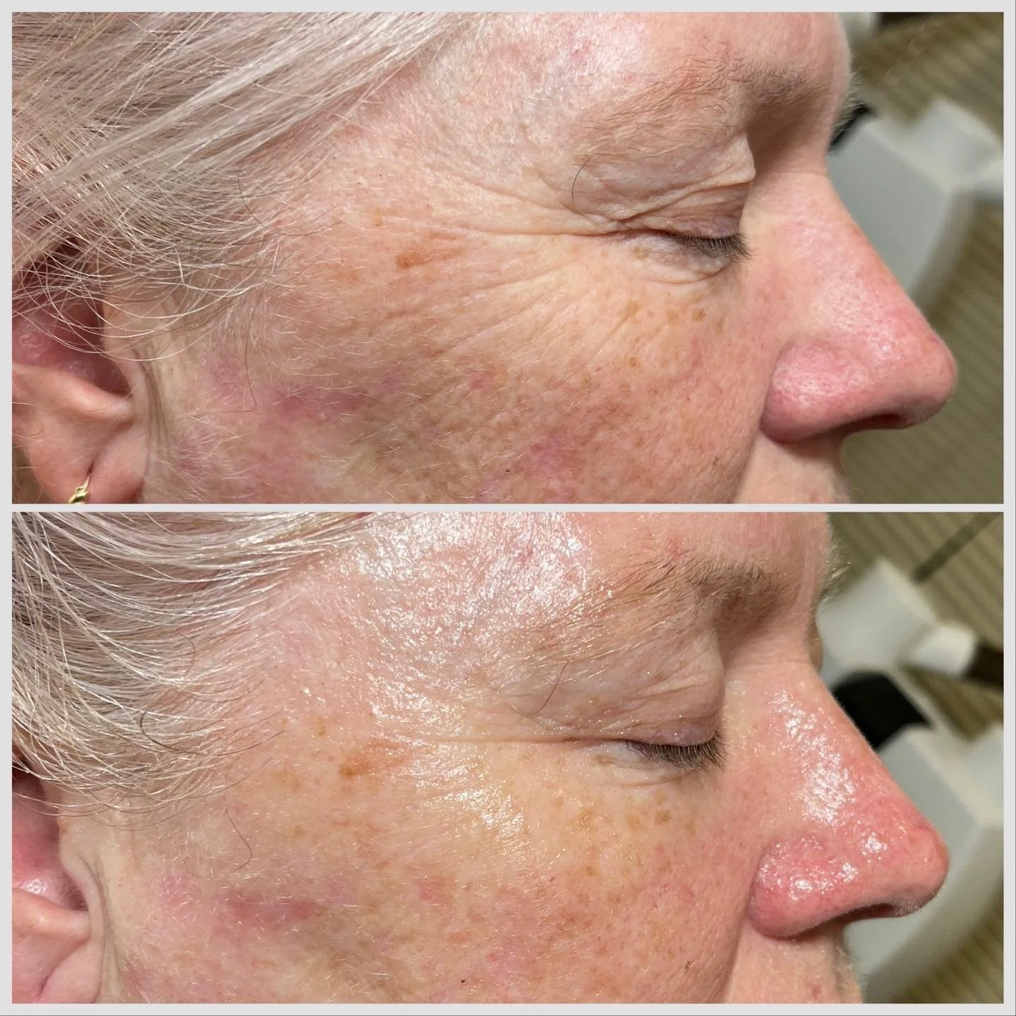 Winter glow-up achieved! ❄️✨ Our Oxygen Facial works wonders, as you can see in this before and after! Instantly hydrated, smoother lines, and a plumped-up radiance just in time for the colder months. Book in to see the magic for yourself! 🌟 #Winter