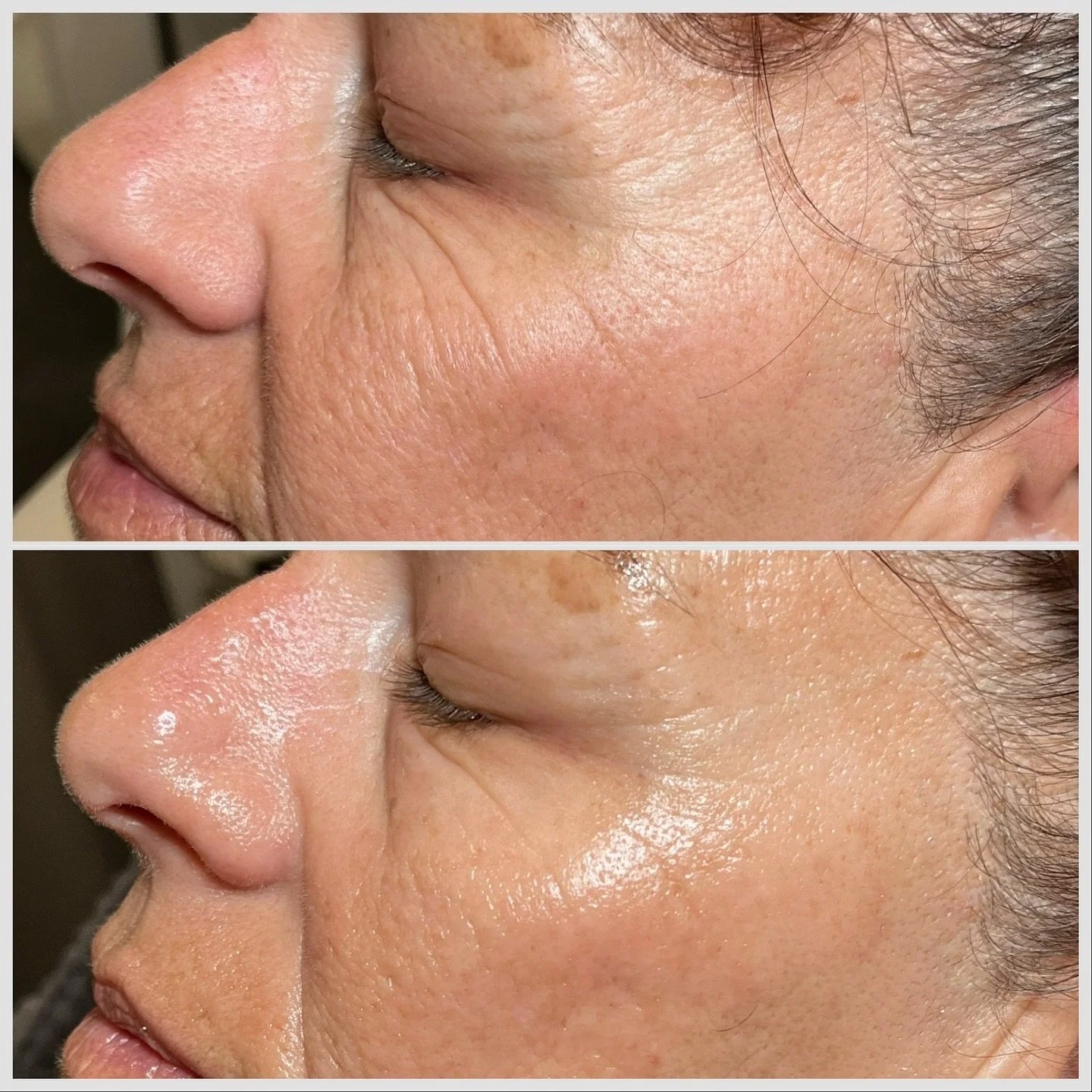 ✨ Winter Glow Alert! ✨ Treat your skin to the luxurious Intraceuticals Oxygen Facial. 💧 This rejuvenating treatment infuses pure oxygen and powerful serums deep into your skin, leaving you hydrated, radiant, and ready to face the winter chill. ❄️ Sa