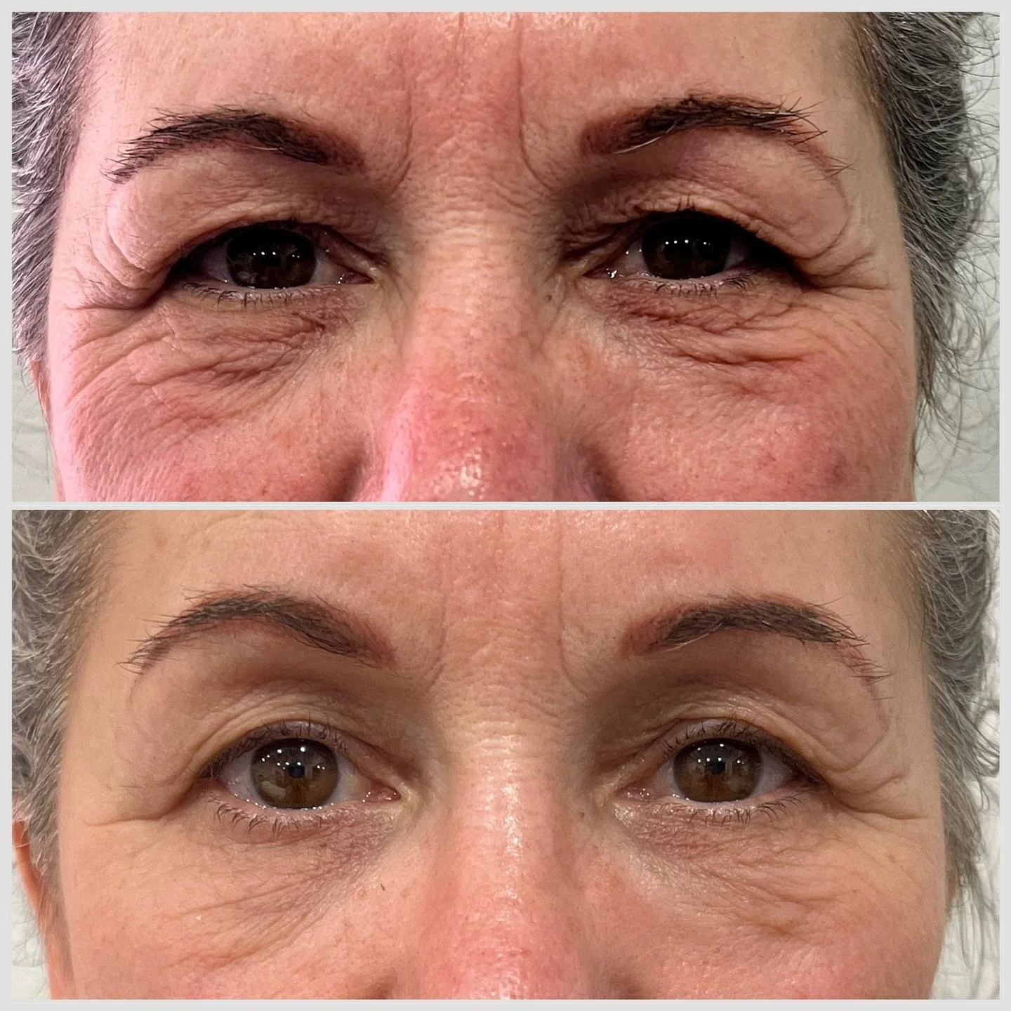 Meet HIFU- High Intensitiy Frequency Ultrasound. 

Using ultrasound energy, HIFU penetrates into your skin layers to stimulate collagen production, giving you :
🌟 a natural look 
🌟 smoother skin texture 
🌟 reduced lines and wrinkles 

This is the 