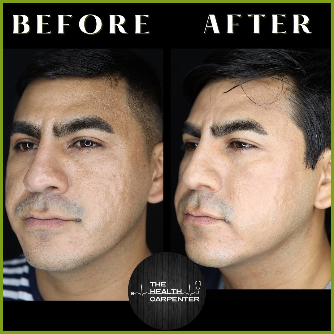 Start your week off with a boost of confidence and a radiant glow! Take a look at  the incredible transformation achieved with RF micro-needling sessions. Here are 3 reasons why RF micro-needling is your go-to treatment as we head into summer:

- Per