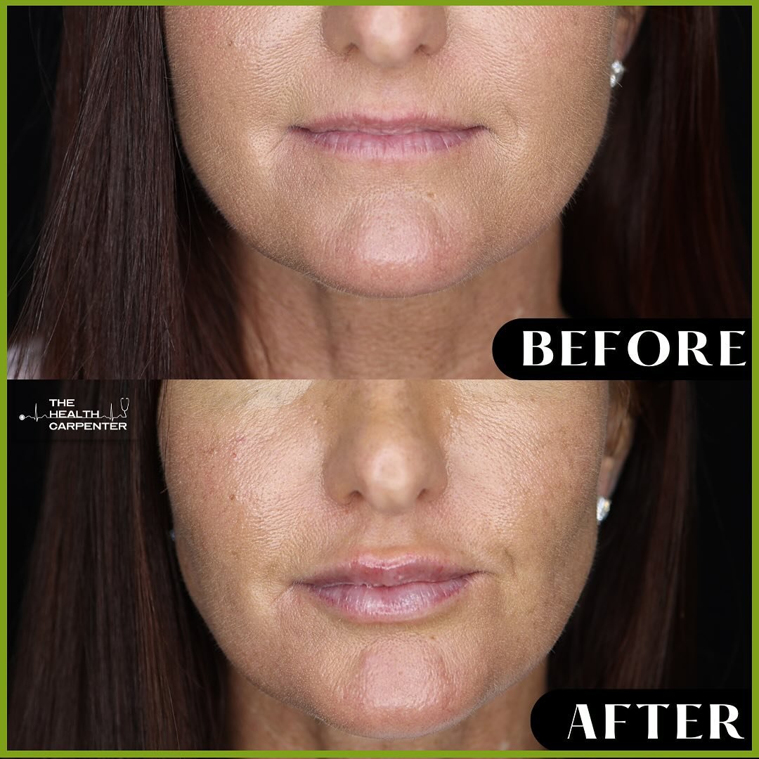 Transforming Tuesday with the perfect pout!💋

Our patient embraced the natural beauty of lip filler
for a summer-ready look. Why should you consider lip filler ?

Achieve fuller, more defined lips instantly. With minimal downtime, there&rsquo;s no b