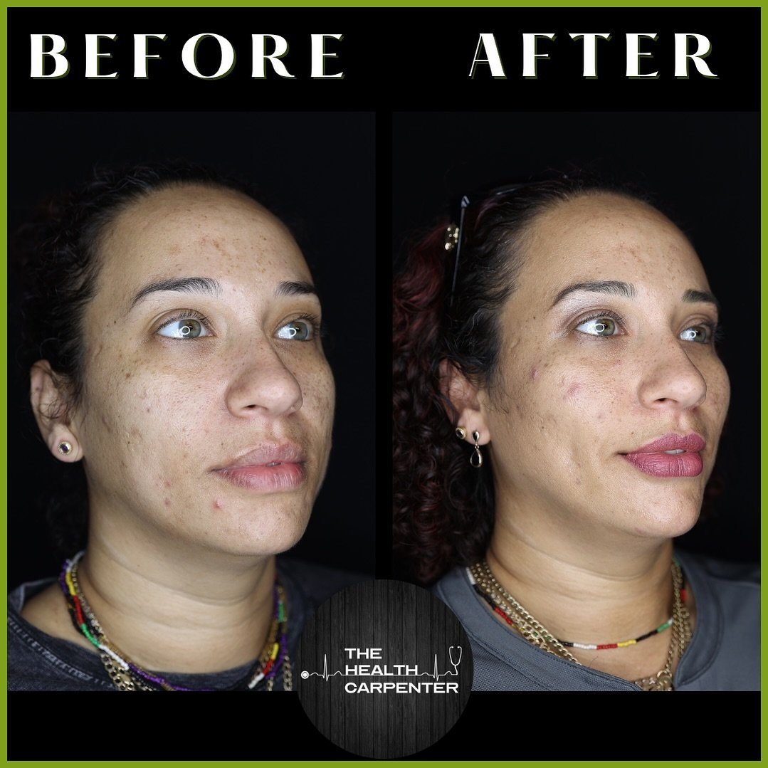 One of our all-time favorite transformations: the stunning before and after of lip and cheek filler! 💋

Not only does this treatment contour and define your features, but it also creates that sought-after natural filter effect, leaving you feeling c