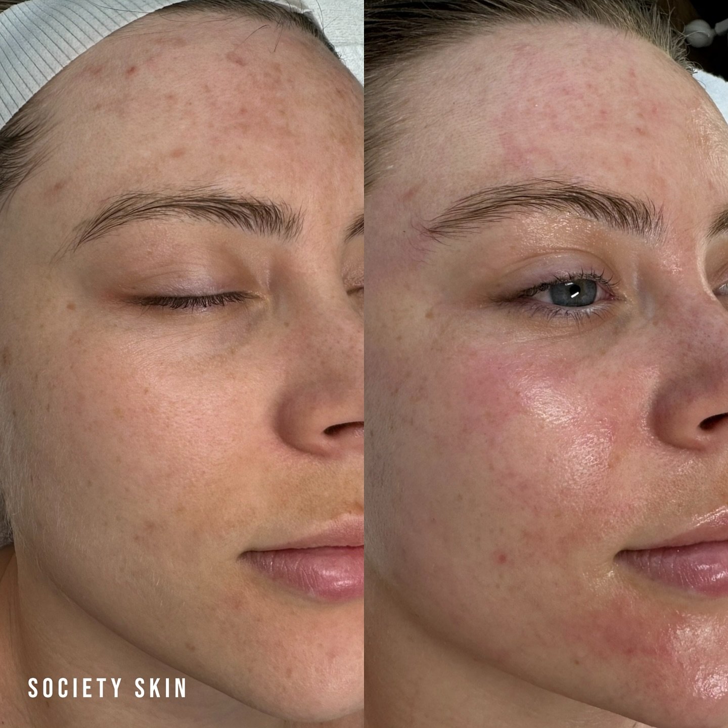 Before &amp; after results on the beautiful @jolenescott_ 🖤

Second image was taken post alkaline and enzyme, showing us the fresh oxygen and blood flowing through her capillaries! Skin barrier has been repaired and now full of H2O and EFAS! 

We lo