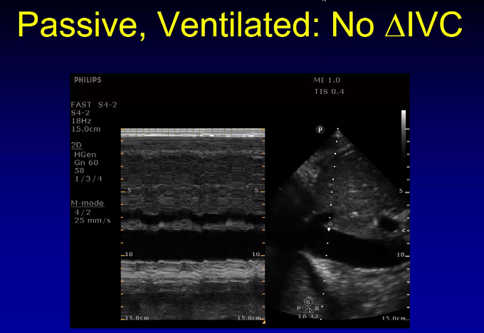 IVC can be measured if the patient is passively ventilated with a big enough tidal volume. It should be measured 2-3 cm from the right atrium ideally. Here is a M-mode demonstration that does not show variability of the IVC which means they are less…