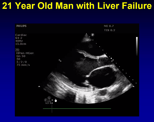 21 year old transferred to ICU for liver transplant evaluation, found to have profound systolic dysfunction on POCUS.