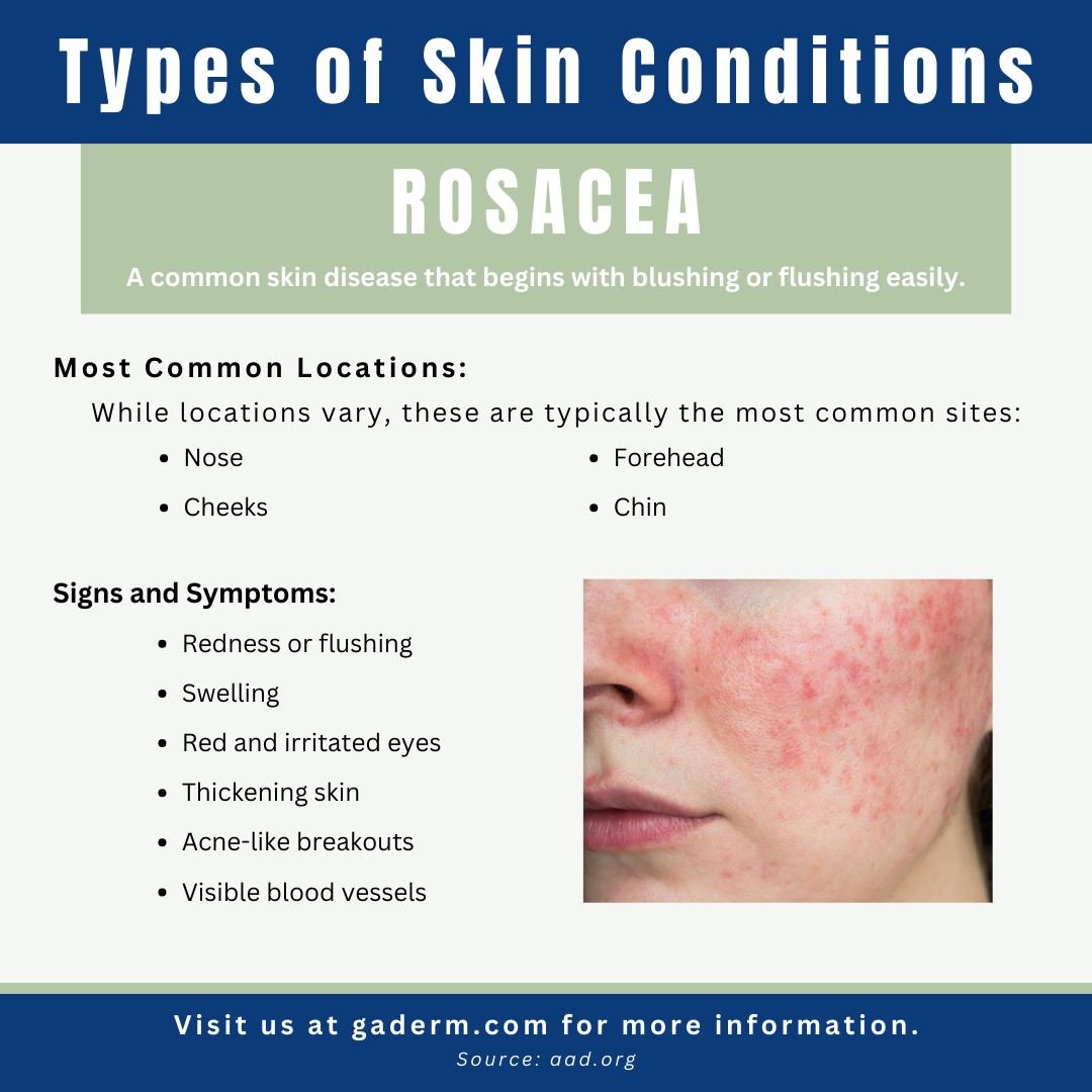 Rosacea is a common skin condition that causes blushing or flushing and visible blood vessels in your face. It may also produce small, pus-filled bumps. These signs and symptoms may flare up for weeks to months and then go away for a while. There's n