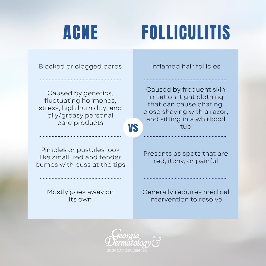 Acne and Folliculitis are extremely common and must be carefully distinguished from one another in order to receive the most effective treatment.

Unique risk factors for each skin condition can make treatment challenging; one topical medication may 